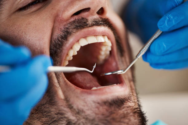 Best Chipped Tooth Repair Near Me  in Wlow Springs, IL